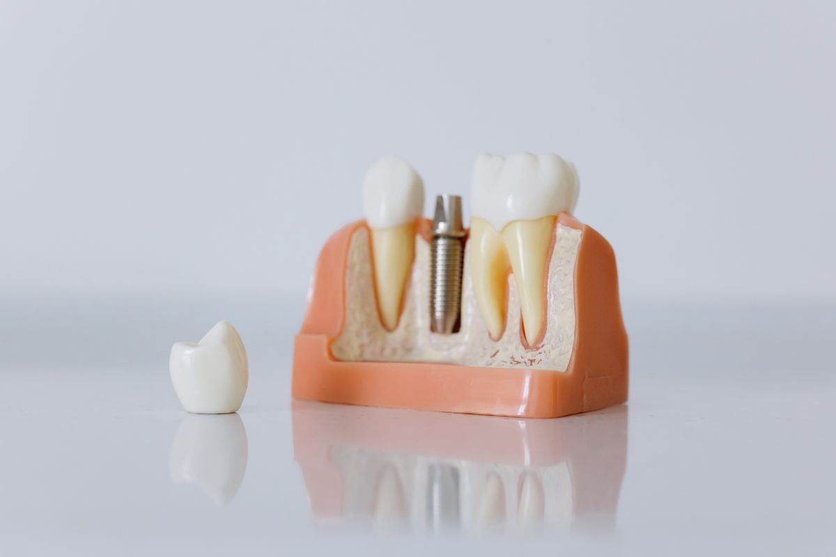 Implant crown on a model