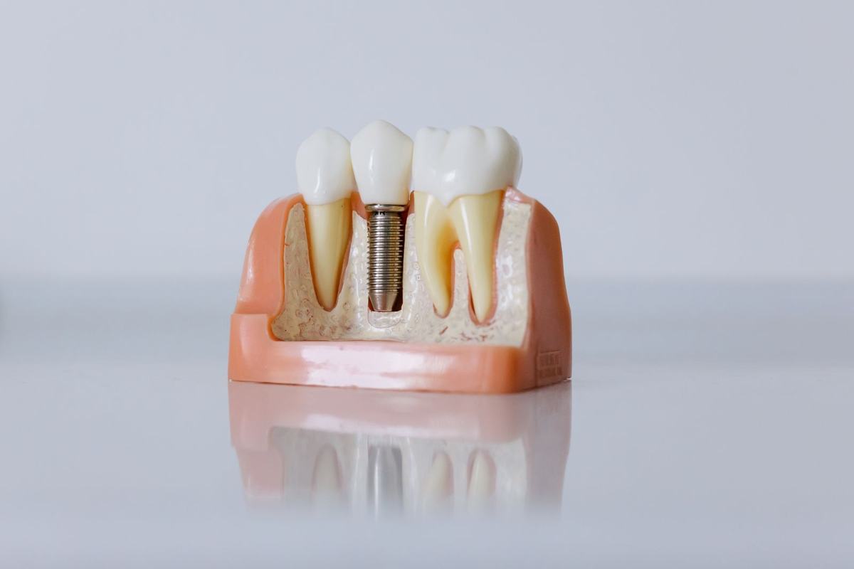 Single-tooth implant model