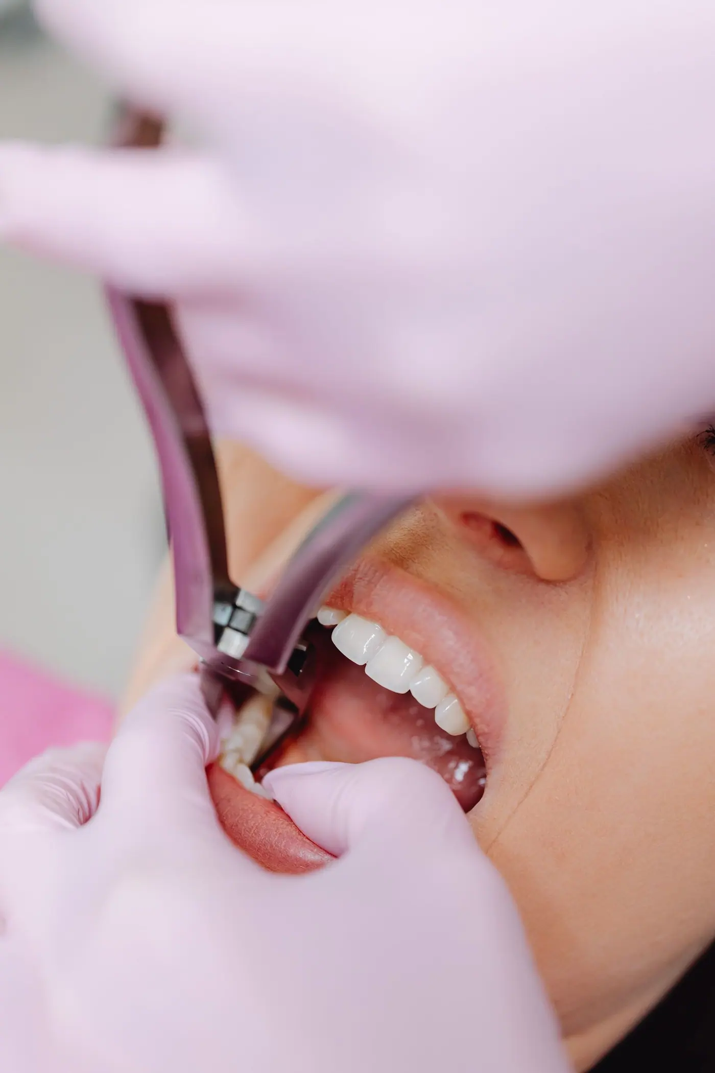 Tooth extraction with forceps