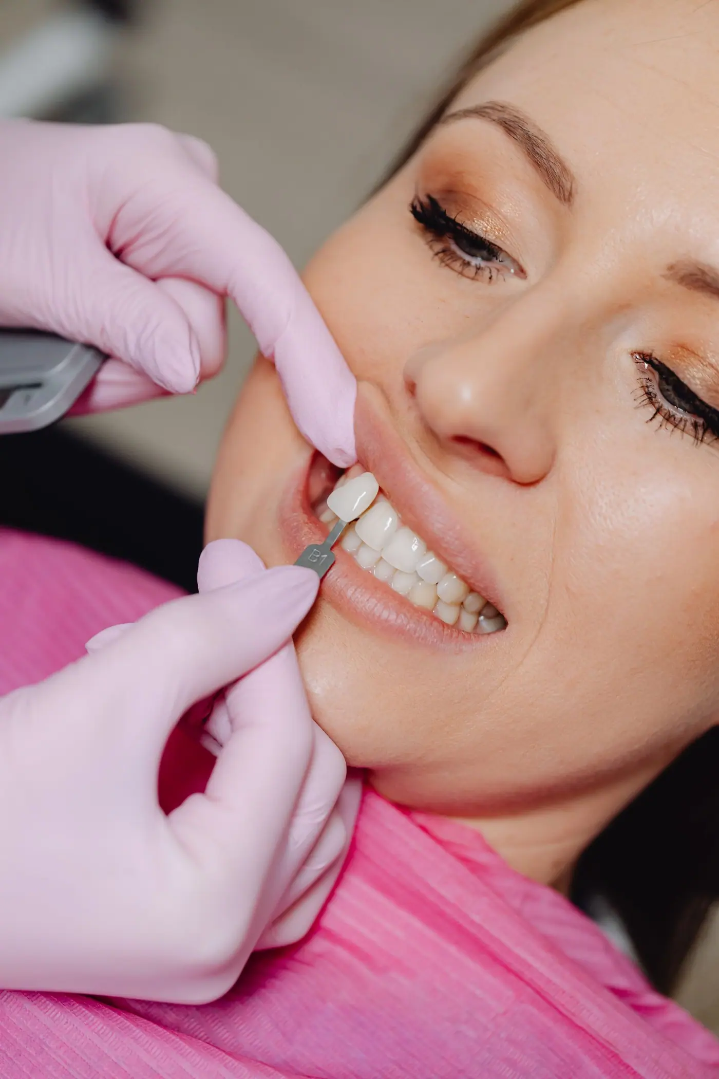 Feinabstimmung eines Veneers