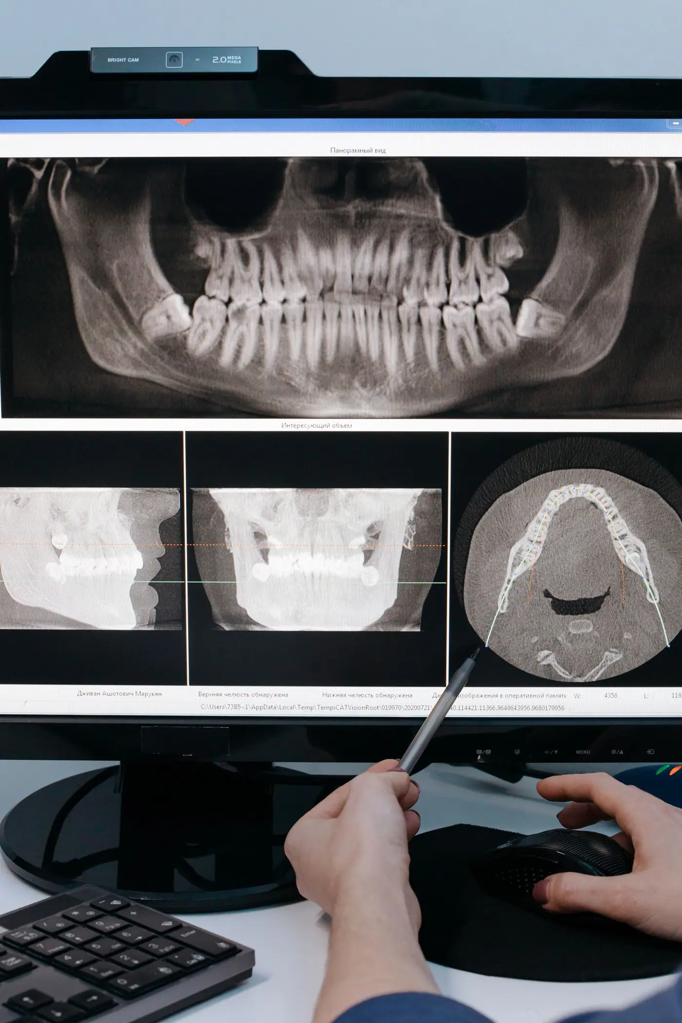 Panoramic X-ray on screen